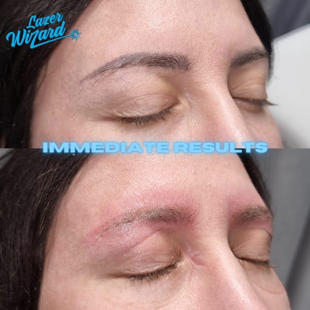 Eyebrow Tattoo Removal: What to Expect & Costs