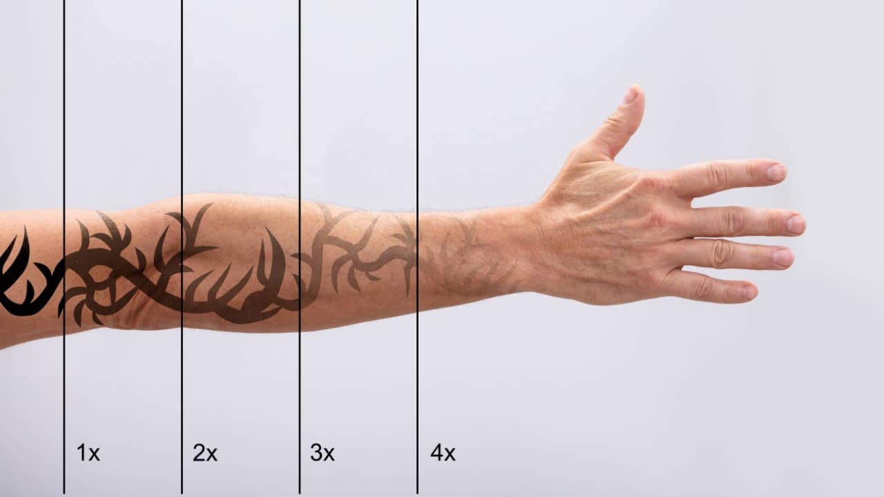 Understanding Tattoo Removal Pricing: What Determines the Cost?