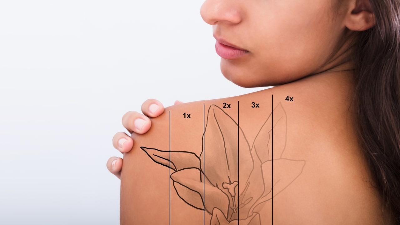 Tattoo Removal Results: How Skin Tone and Ink Colour Affect Fading